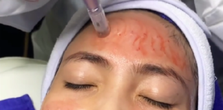 Cara Ampuh Mengatasi Bopeng Bekas Jerawat