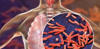 Tuberkolosis Terbesar Ketiga di Dunia, Indonesia Akan Skrining Besar-Besaran